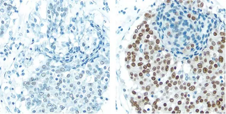 Breast Carcinoma Blue Brown