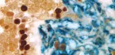 Breast Carcinoma Brown