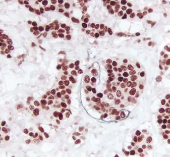 Breast Carcinoma Hrp Substrate Gray Black