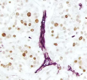 Breast Carcinoma Vector Vip Purple