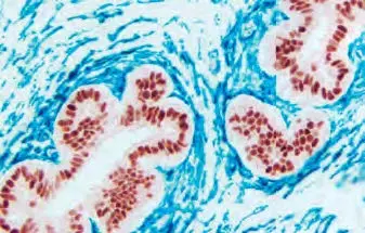 Breast Carcinoma Blue