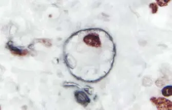 Breast Carcinoma Gray Black