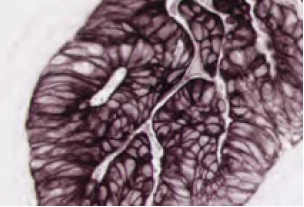 Colon Carcinoma Pan Cytokeratin Brown Black