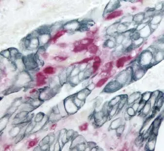 Colon Carcinoma Sg Hrp Substrate Blue Gray