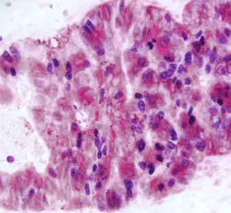 Colon Cancer Red