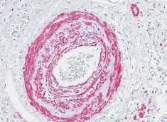 Lung Asma