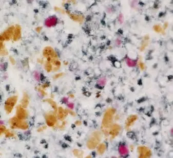 Melanoma Brown Pigments