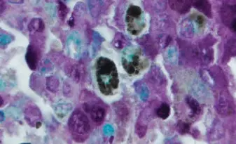 Melanoma Methyl Green Counterstain