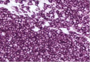 Tonsil Cd20 Purple