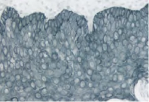 Tonsil Cytokeratin Ae1 Blue Gray