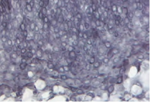 Tonsil Cytokeratin Ae1 Gray Black