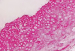 Tonsil Cytokeratin Ae1 Magenta