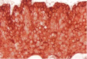 Tonsil Cytokeratin Ae1 Red