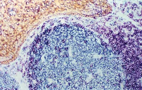 Tonsil Multi Cytokeratin