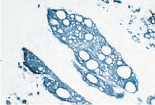 Tumor Cytokeratin Blue