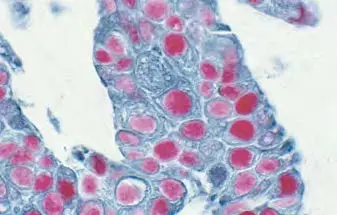 Tumor Substrate Blue Gray