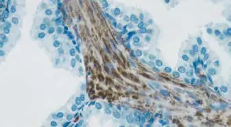 Tumor Tissue Counterstain Blue