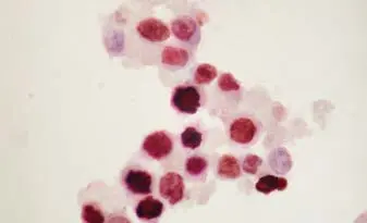 Cytospin Of Ebv Novared
