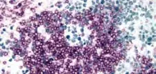 Tonsil Blue Gray