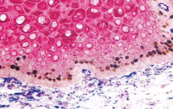 Tumor Ki67