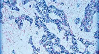 Tumor Counterstain Red