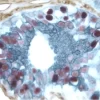Breast Cancer (triple label): Estrogen receptor (red, Vector NovaRED), endothelium (brown, Vector DAB), epithelium (blue/gray, Vector SG).