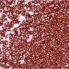 Tonsil: CD20 (m), ImmPRESS HRP Anti-Mouse IgG, Vector NovaRED Substrate.