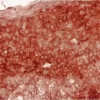 Tonsil: AE1/AE3 (m), ImmPRESS HRP Anti-Mouse IgG, Vector NovaRED Substrate.