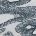 Colon Carcinoma: Ae1/Ae3 (M), Immpress Reagent (Hrp), Vector Sg Substrate (Gray).