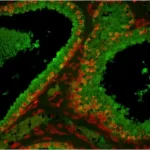 Prostate: Prostate Specific Antigen (Rp), Fluorescein Labeled Using The Proton Fluorescein Labeling Kit. Propidium Iodide Counterstain (Red). Mounted In Vectashield Hardset Mounting Medium.