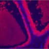 Prostate: Prostate Specific Antigen (rp) labeled with fluorescein using the ProtOn Fluorescein Labeling Kit. Fluorescein label detected with Alkaline Phosphatase Anti-Fluorescein and visualized with Vector Red. Mounted in VECTASHIELD HardSet Mounting Medi