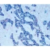 Tumor tissue section showing specific cytoplasmic cell staining (blue/gray, Vector SG) with Vector Nuclear Fast Red (red) counterstain.