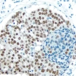 Breast Carcinoma: With Citrate-Based Antigen Unmasking Solution, Estrogen Receptor (Rm), Immpress Anti-Rabbit Ig Kit, Dab (Brown) Substrate. Hematoxylin Qs (Blue) Counterstain.