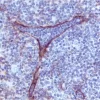 Lymphoma: Lymphatic endothelium stained using mouse monoclonal antibody against M2A antigen (clone D2-40; Cat. No. VP-M671), ImmPress anti-mouse Ig reagent (MP-7402), and Vector NovaRED peroxidase substrate (SK-4800; red). Hematoxylin QS counterstain (blu