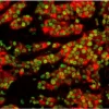 Breast Carcinoma (frozen, double label): Estrogen Receptor (m), MOM Fluorescein Kit (green); Multi-Cytokeratin (m), MOM Basic Kit, VECTASTAIN ABC-AP Standard Kit, Vector Red AP substrate (red).
