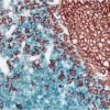 Tonsil (double label): CD3 (m), VECTASTAIN Universal ABC-AP Kit, Vector Blue substrate (blue); CD20 (m), ImmPRESS Universal Reagent, Vector NovaRED substrate (red).