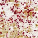 Lymph Node (Double Label): Ki67 (M), Vectastain Universal Abc-Ap Kit, Vector Red Substrate (Red); Multi-Cytokeratin (M), Vectastain Universal Elite Abc Kit, Dab Substrate (Brown).