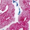 Tumor (double label): CD34 (m), VECTASTAIN Universal ABC-AP Kit, Vector Blue AP substrate (blue); Cytokeratin 8/18 (m), VECTASTAIN Universal ABC-AP Kit, Vector Red substrate (red).