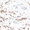 Breast Carcinoma: Progesterone Receptor (rm), ImmPRESS Universal Antibody Kit, DAB Substrate Kit (brown). Hematoxylin QS counterstain (blue).