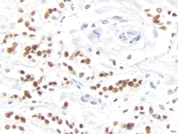 Breast Carcinoma: Progesterone Receptor (Rm), Immpress Universal Antibody Kit, Dab Substrate Kit (Brown). Hematoxylin Qs Counterstain (Blue).