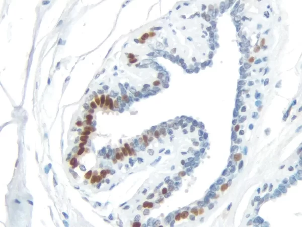 Breast Carcinoma: Progesterone Receptor (Rm), Immpress Universal Antibody Kit, Dab Substrate Kit (Brown). Hematoxylin Counterstain (Blue).