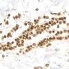 Breast Carcinoma: Estrogen Receptor (rm), ImmPRESS Universal Antibody Kit, DAB substrate Kit (brown). Hematoxylin QS counterstain (blue).