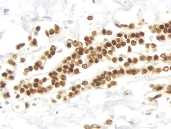 Breast Carcinoma: Estrogen Receptor (Rm), Immpress Universal Antibody Kit, Dab Substrate Kit (Brown). Hematoxylin Qs Counterstain (Blue).