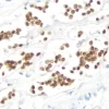 Breast Carcinoma: Estrogen Receptor (rm), ImmPRESS Universal Antibody Kit, DAB substrate Kit (brown). Hematoxylin QS counterstain (blue).