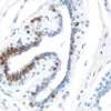 Breast Carcinoma: Estrogen Receptor (rm), ImmPRESS Universal Antibody Kit, DAB substrate Kit (brown). Hematoxylin QS counterstain (blue).