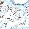 Breast: Estrogen Receptor (m), ImmPRESS Anti-Mouse Ig Kit, DAB Substrate Kit (brown). Hematoxylin counterstain (blue).