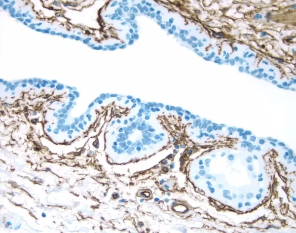 Breast: Estrogen Receptor (M), Immpress Anti-Mouse Ig Kit, Dab Substrate Kit (Brown). Hematoxylin Counterstain (Blue).