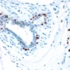 Breast Cancer: Estrogen receptor stained using VECTASTAIN Elite ABC Kit and Vector DAB (brown) substrate. Hematoxylin QS (blue) counterstain.