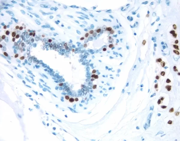 Breast Cancer: Estrogen Receptor Stained Using Vectastain Elite Abc Kit And Vector Dab (Brown) Substrate. Hematoxylin Qs (Blue) Counterstain.