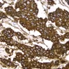 Breast Cancer: c-erbB2 oncoprotein stained using VECTASTAIN Elite ABC Kit and Vector DAB (brown) substrate. Hematoxylin QS (blue) counterstain.